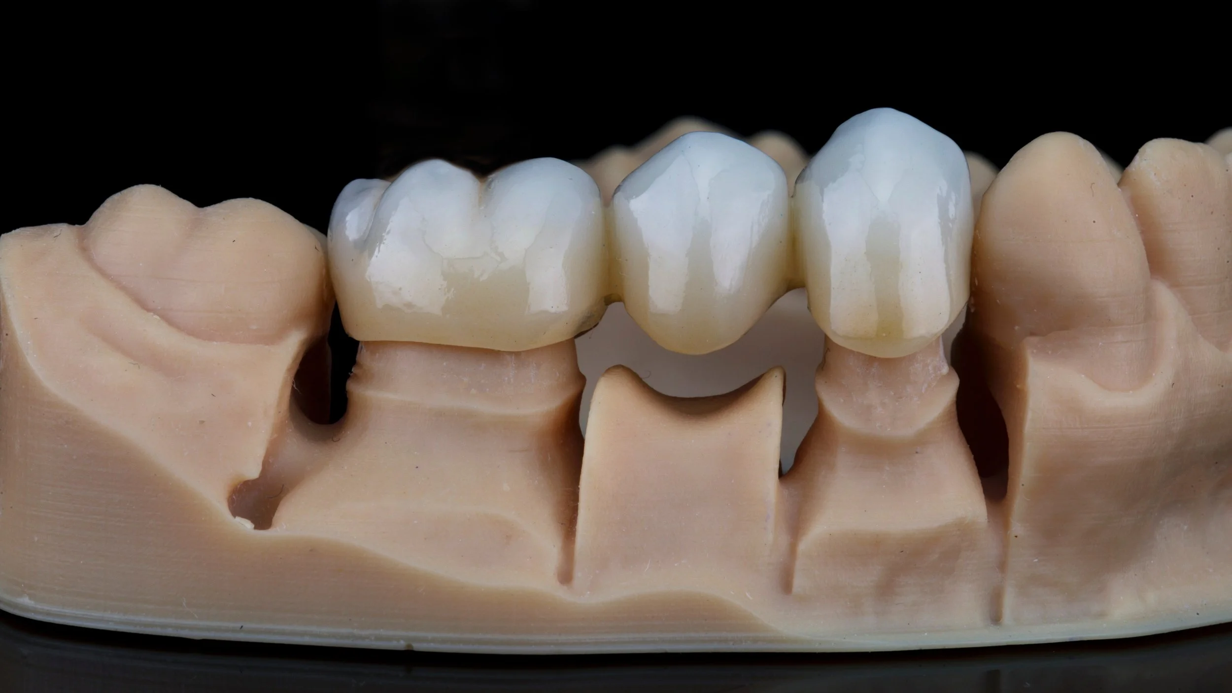 Zirconia crown and bridge