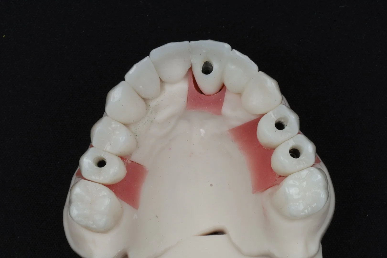 Zirconia crown and bridge