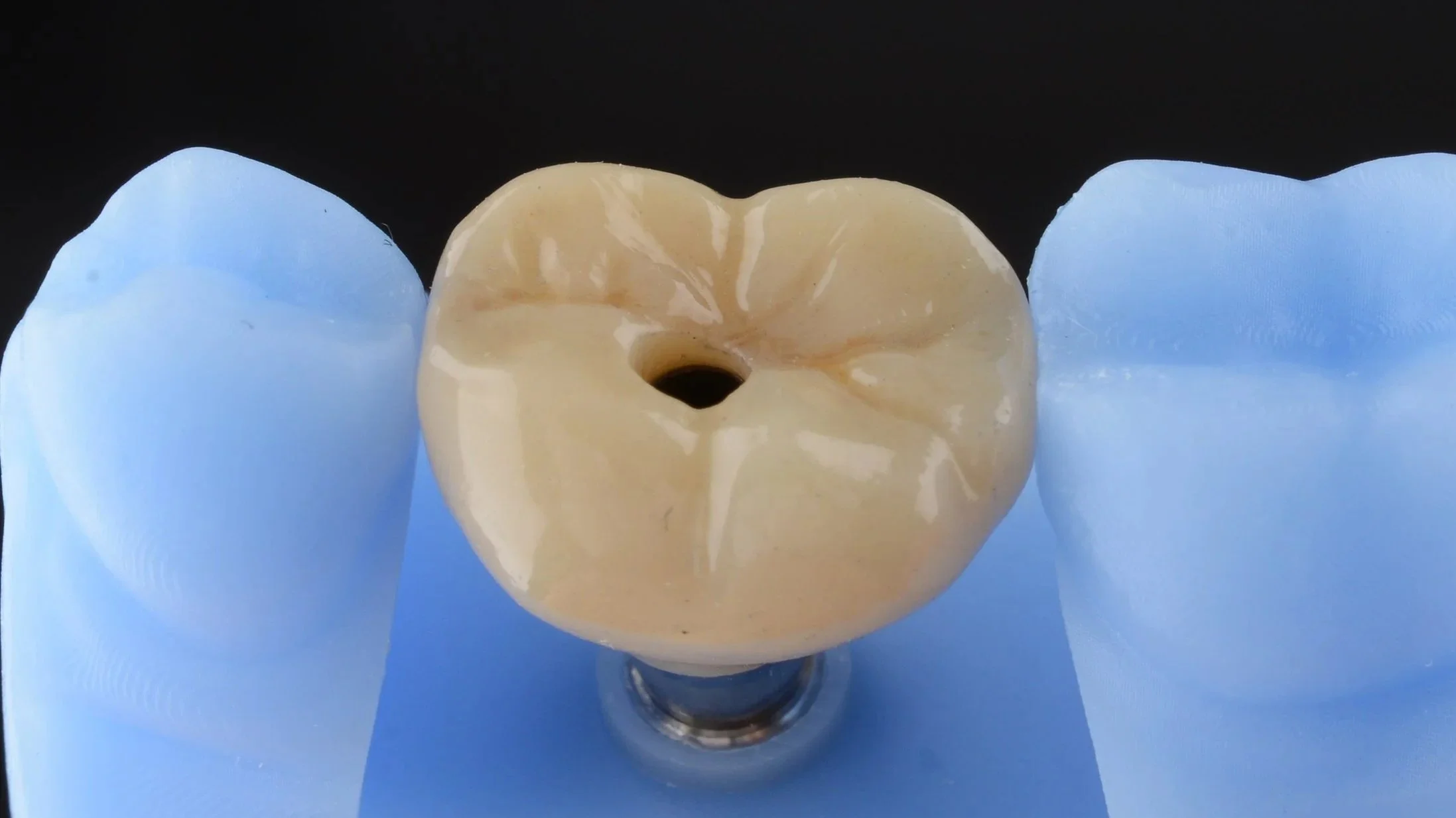 Zirconia crown and bridge