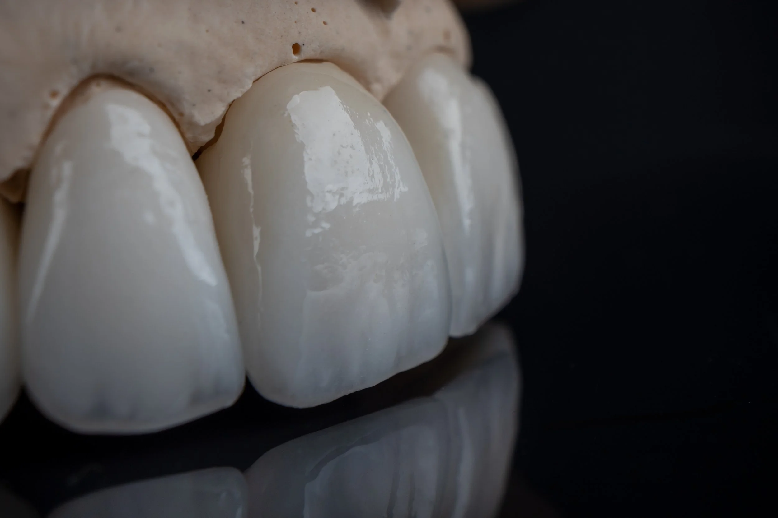 Zirconia crown and bridge